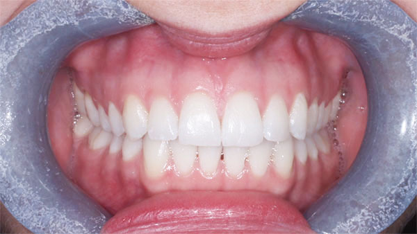 After dental treatment