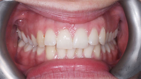 Before dental treatment