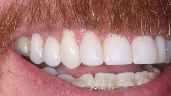 After dental treatment