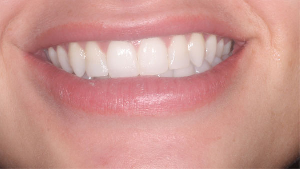 After dental treatment