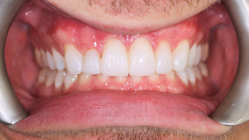 After dental treatment