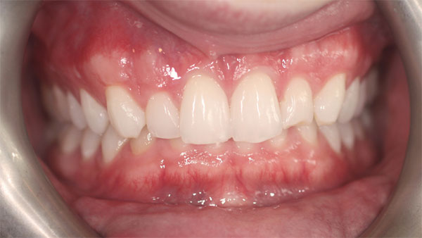 Before dental treatment