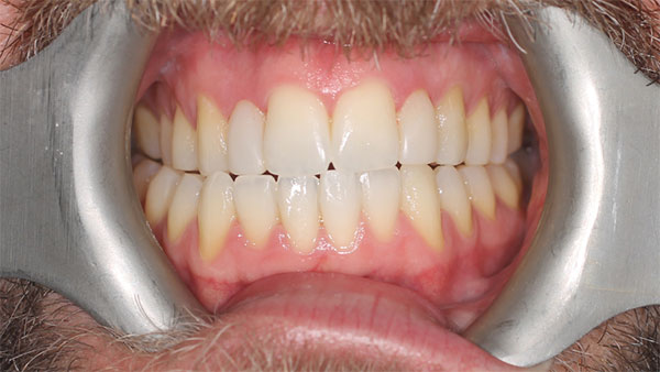 After dental treatment