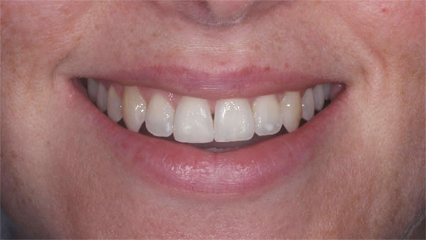 After dental treatment