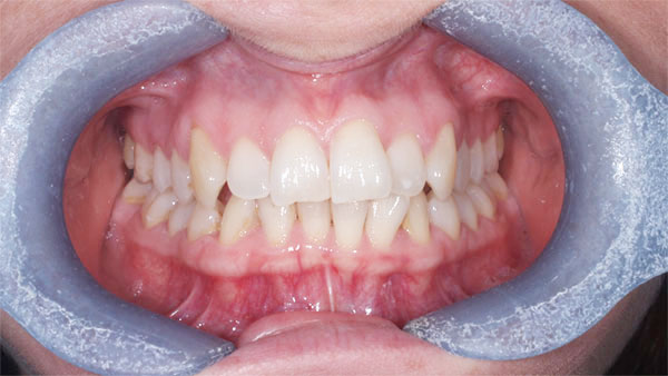 Before dental treatment