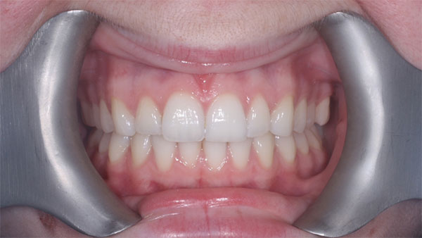 After dental treatment