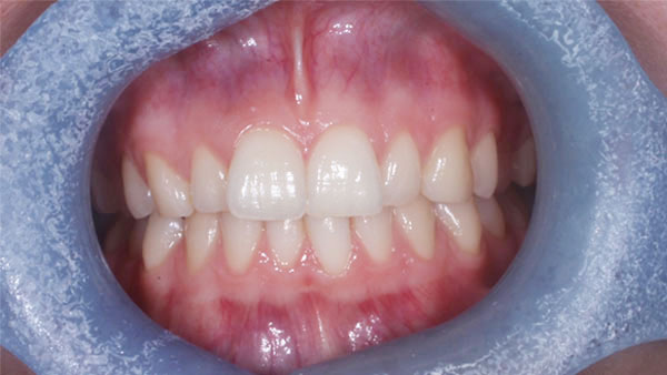 Before dental treatment