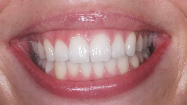 After dental treatment