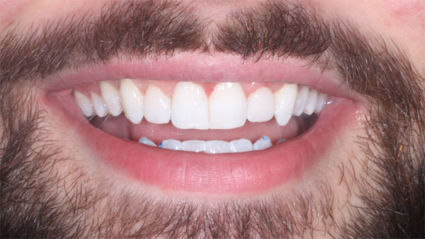 After dental treatment