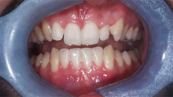 Before dental treatment