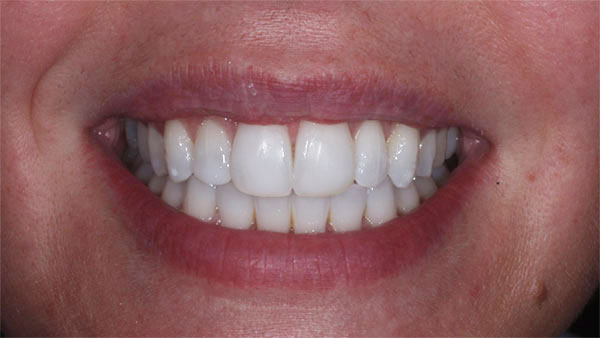 After dental treatment