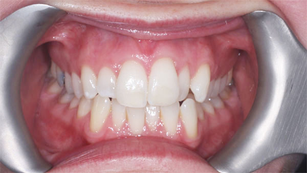 Before dental treatment