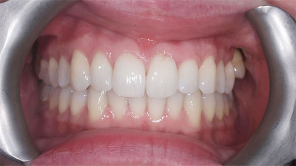 After dental treatment