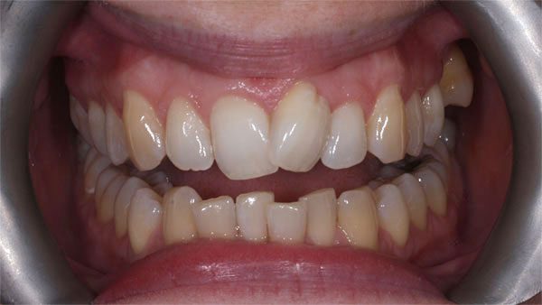 Before dental treatment