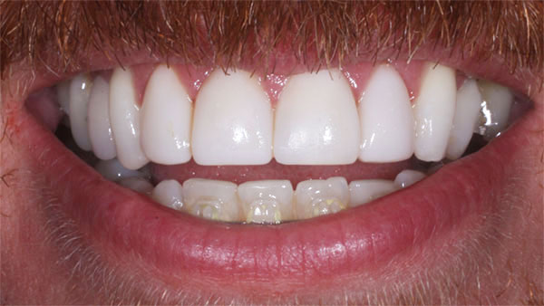 After dental treatment